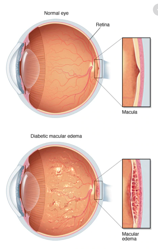 Advanced retinal disease treatment