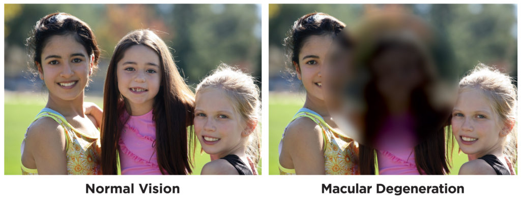 Macular Degeneration at Best Eye Hospital in Bathinda | Vasu Eye Institute & Skin Centre