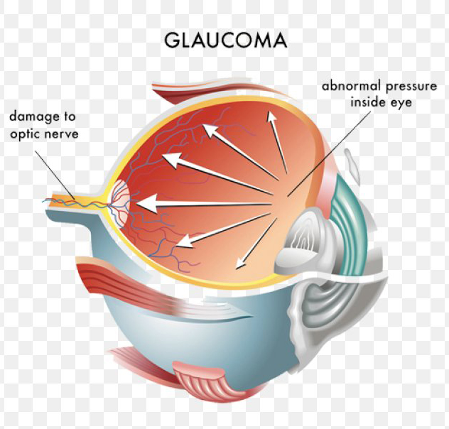 Glaucoma treatment Bathinda
