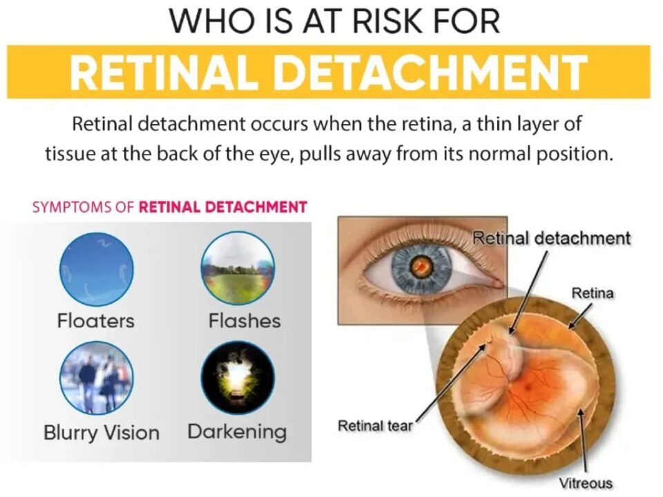 Is Your Vision at Risk? Find Out Why Vasu Eye Institute is the Best for Retina Care!