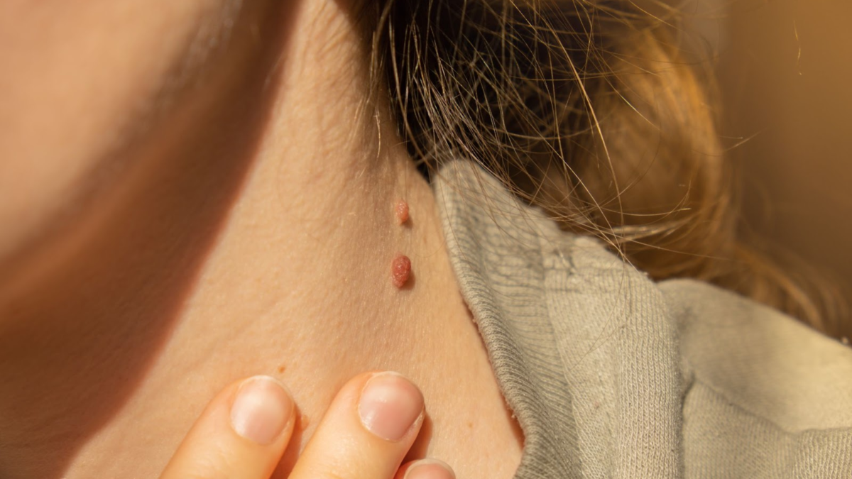 Warts Skin tags removal Bathinda