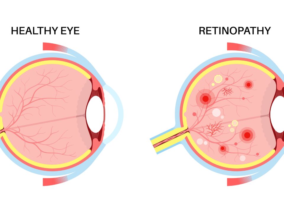 How Diabetes Affects the Retina (And How to Prevent Vision Loss)