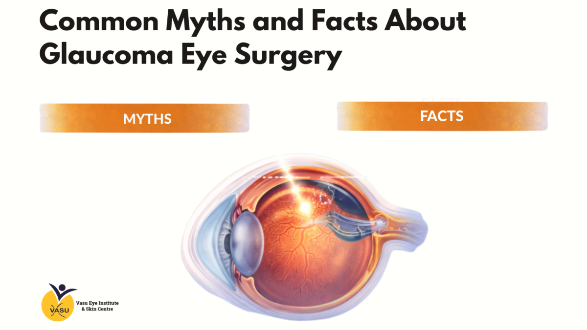 Common Myths and Facts About Glaucoma Eye Surgery