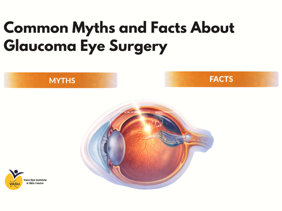 Common Myths and Facts About Glaucoma Eye Surgery